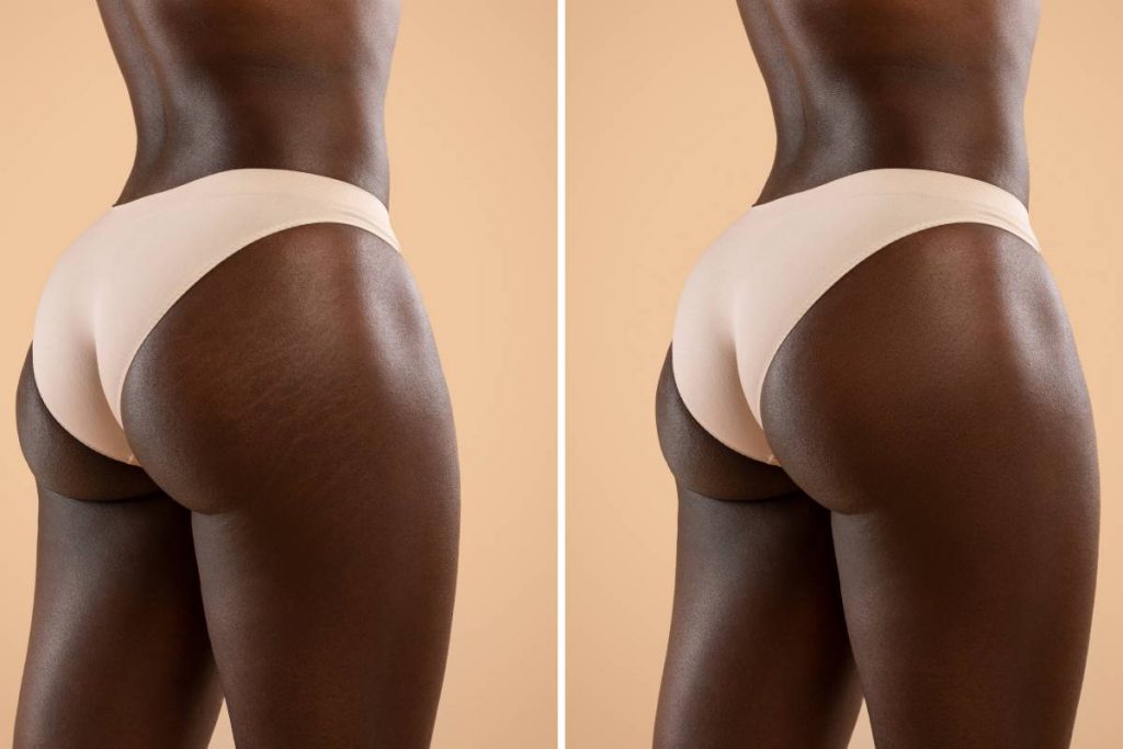 Collage for before and after massage, liposuction, soothing beauty products using results concept, unrecognizable black woman showing her buttocks with and without stretch marks, two shots, panorama